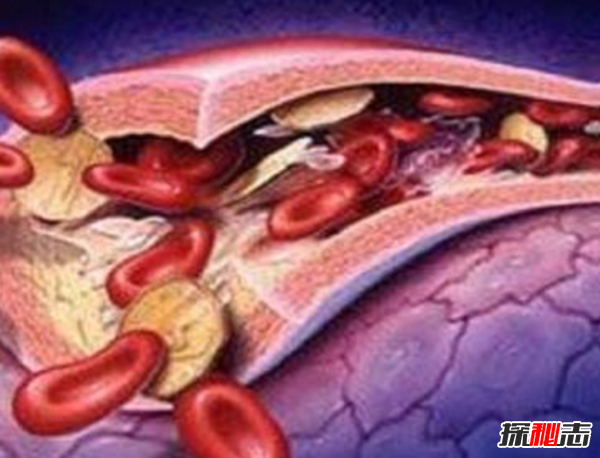 卟啉病為什么要喝血?卟啉病真實(shí)患者圖片(吸血鬼的原型病)