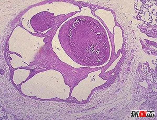 卟啉病為什么要喝血?卟啉病真實(shí)患者圖片(吸血鬼的原型病)