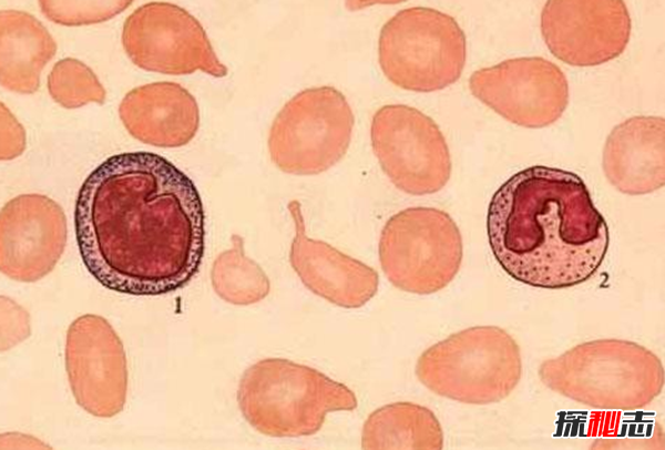 卟啉病為什么要喝血?卟啉病真實(shí)患者圖片(吸血鬼的原型病)
